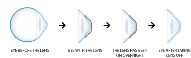 corneal reshaping process